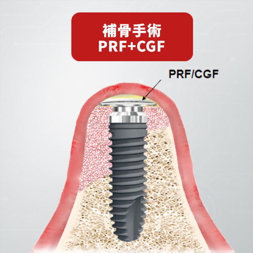 Membrane Screw｜精準補骨解決方案