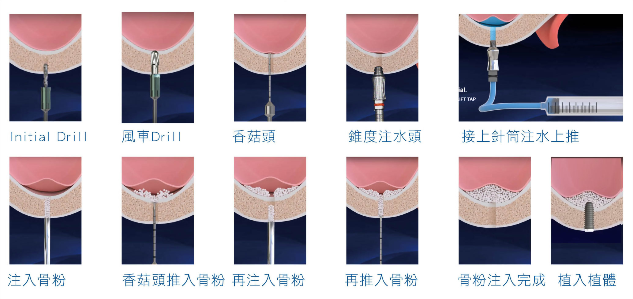 輔助植牙手術方式