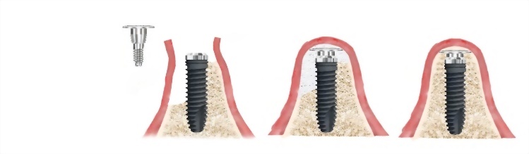 Membrane Screw水平重直補骨