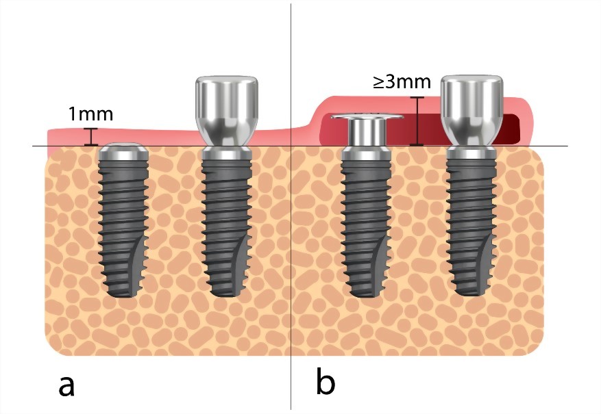 Membrane Screw vs. Cover Screw 對比