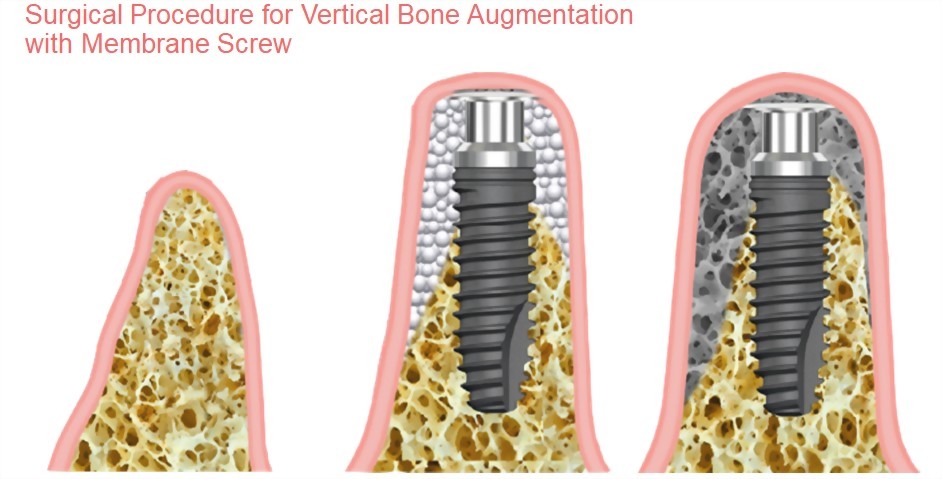 手術流程步驟圖