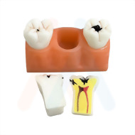 蛀牙模型 12x6.2x6.5cm
