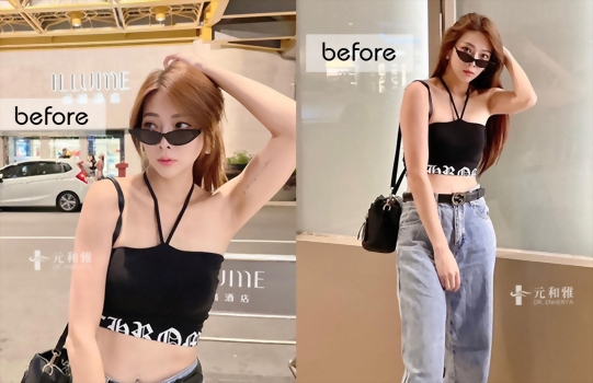 魔滴2.0MotivaJOY隆乳新視野！網紅油條兄弟柳橙的白幼瘦升級之旅(未完待續)