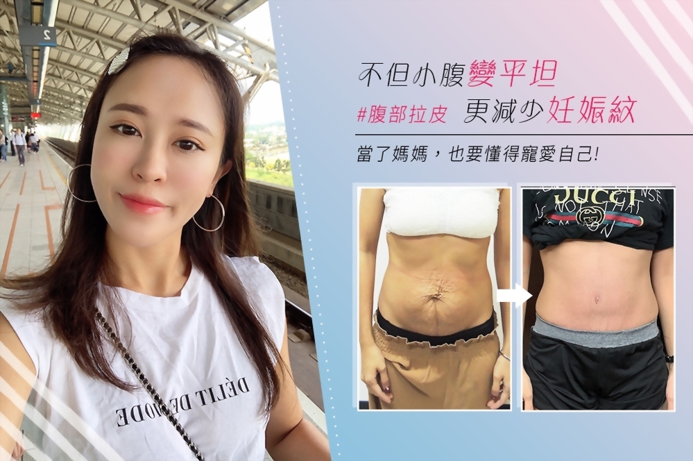 媽媽的滿”腹”委屈-腹部拉皮