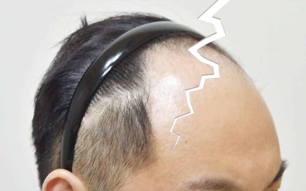 嚴重落髮是你心中的恐懼嗎？